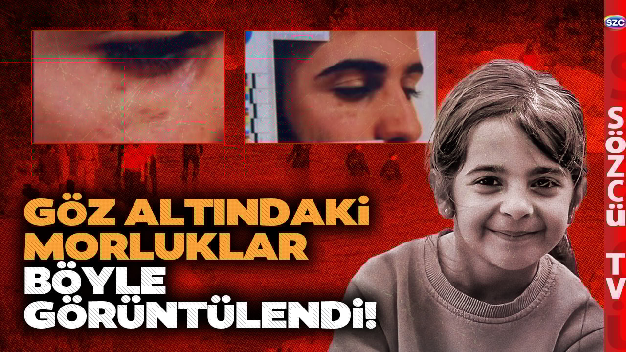 Narin'in Abisi Enes Güran'ın Isırık İzleri Ortaya Çıktı! Yüzdeki Morluklar Dikkat Çekti