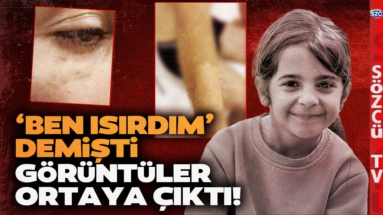 Narin Güran Cinayetinde Yeni Detaylar! Enes Güran'ın Kolundaki Isırık İzleri Ortaya Çıktı